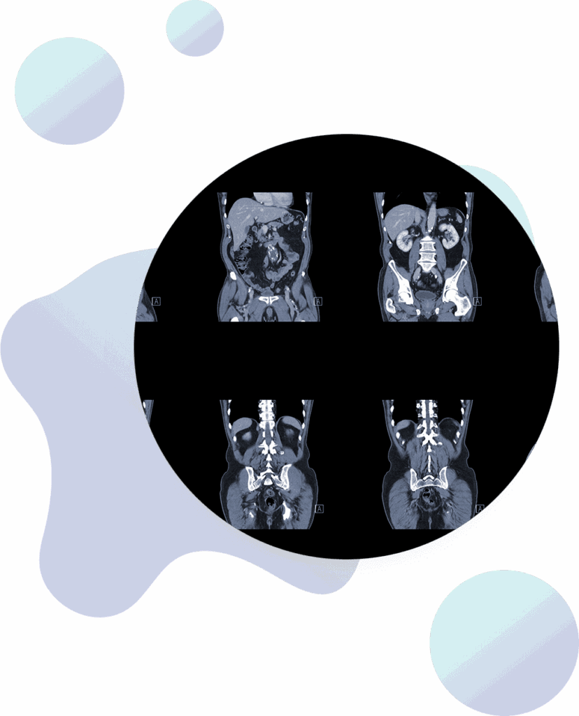 A circular collage of six grayscale medical scans, likely CT or MRI images of the abdomen and pelvis, displayed on a black background with abstract pastel shapes in the corners.