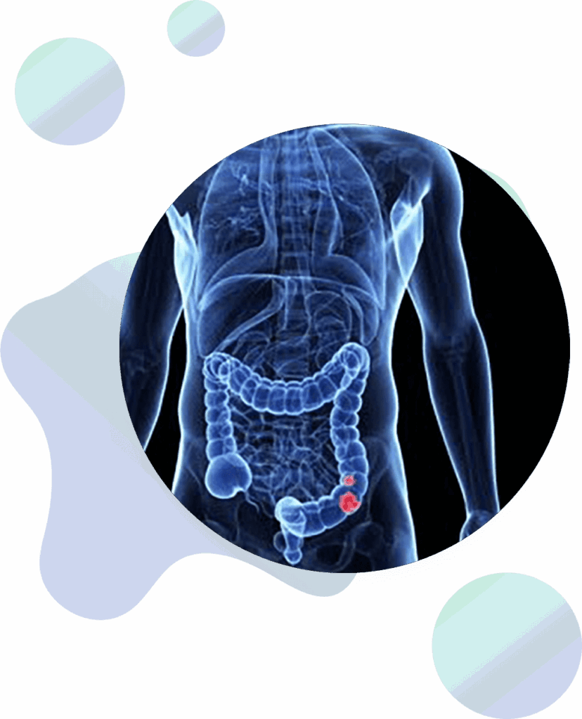 A medical illustration shows a transparent view of a human torso with the colon highlighted. A red area in the lower part of the colon indicates a possible abnormality or disease, such as colon cancer.
