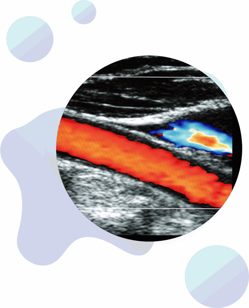 A circular cutout of a Doppler ultrasound image shows a blood vessel in red and blue against a grayscale background, overlaid on an abstract design with pastel shapes.