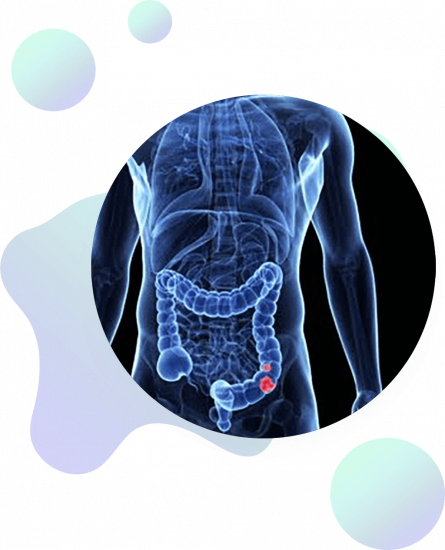 A medical illustration shows a transparent view of a human torso with the colon highlighted. A red area in the lower part of the colon indicates a possible abnormality or disease, such as colon cancer.