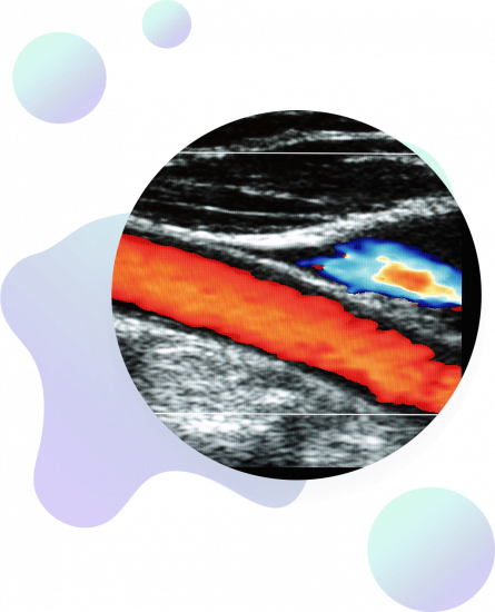 A circular cutout of a Doppler ultrasound image shows a blood vessel in red and blue against a grayscale background, overlaid on an abstract design with pastel shapes.